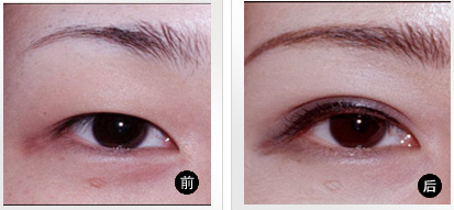 上瞼下垂矯正