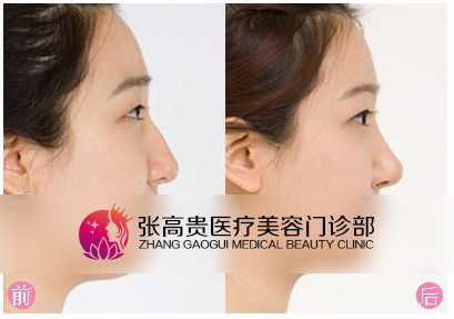 駝峰鼻矯正前后對比