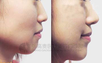 駝峰鼻矯正前后對比