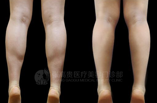 呼和浩特瘦腿針