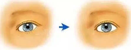 做上瞼下垂手術有風險嗎