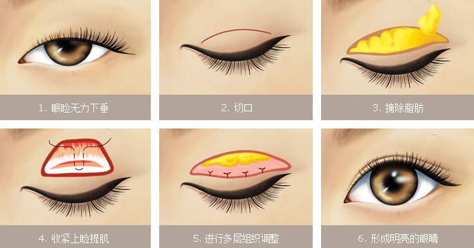 上瞼下垂怎么辦