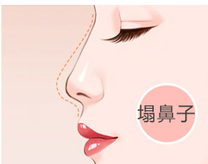 玻尿酸隆鼻的維持時間是多久