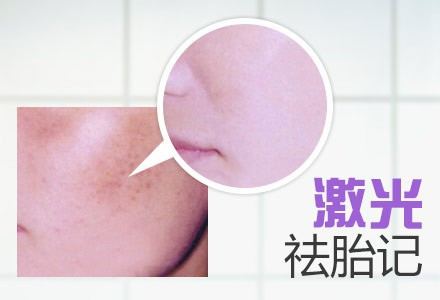 呼和浩特激光祛斑