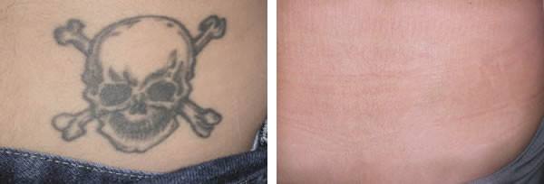 呼和浩特整形醫(yī)院激光洗紋身適合哪個人