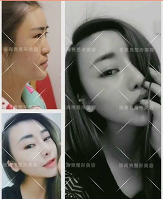 呼和浩特整形醫(yī)院假體隆鼻能夠維持多長時間呢