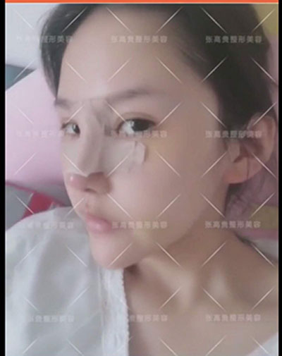 呼和浩特整形醫(yī)院鼻部整形的方式有哪些