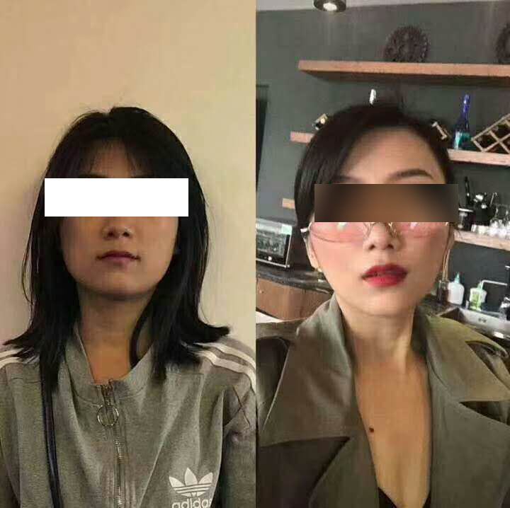 呼和浩特整形醫(yī)院哪些人不適合打瘦臉針