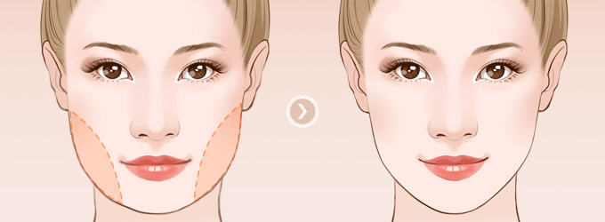 呼和浩特整形面部吸脂多少錢(qián)