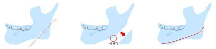 呼和浩特整形下頜角手術會不會留下疤痕