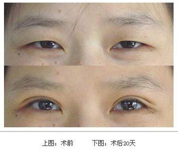 呼和浩特雙眼皮整形割雙眼皮好還是埋線好呢