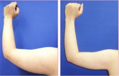 �����ֱ۳�֬���g(sh��)����Ҫ����o(h��)��?