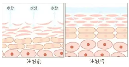 注射完水光針后的注意事項