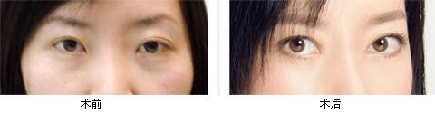 呼市整形醫(yī)院開眼角