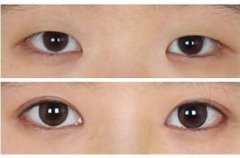 �p��Ƥ���g(sh��)��ע�����(xi��ng)����Щ?