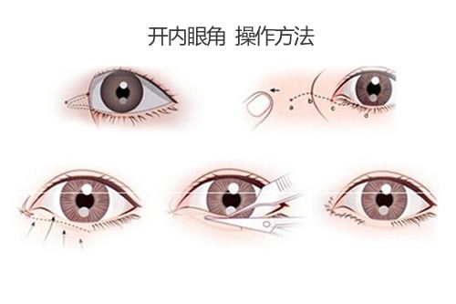 呼和浩特開外眼角手術(shù)效果怎么樣