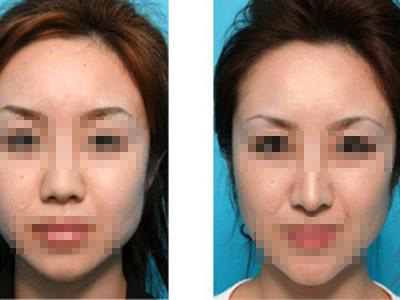 呼和浩特做隆鼻整形多少錢(qián)