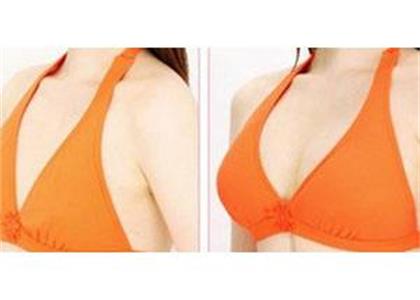 呼和浩特自體豐胸