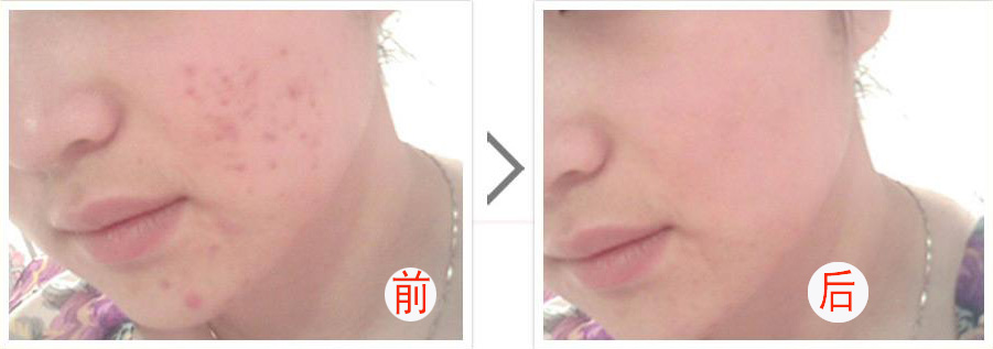 光子嫩膚多少錢(qián)