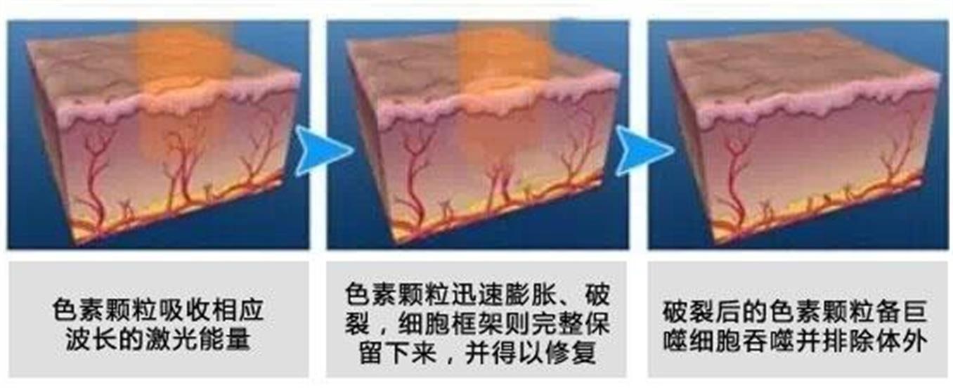 呼和浩特激光祛胎記多少錢