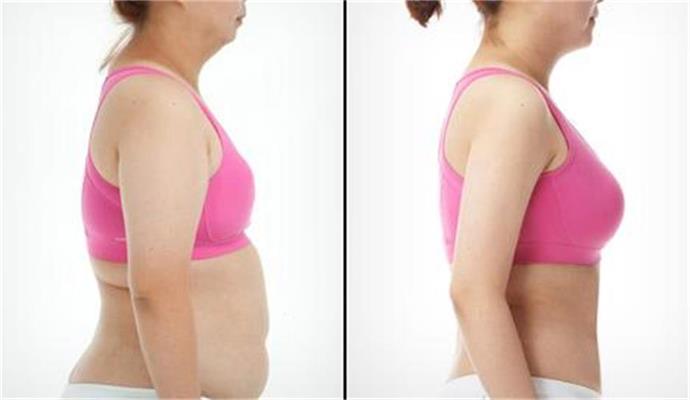 呼和浩特做自體脂肪豐胸多少錢