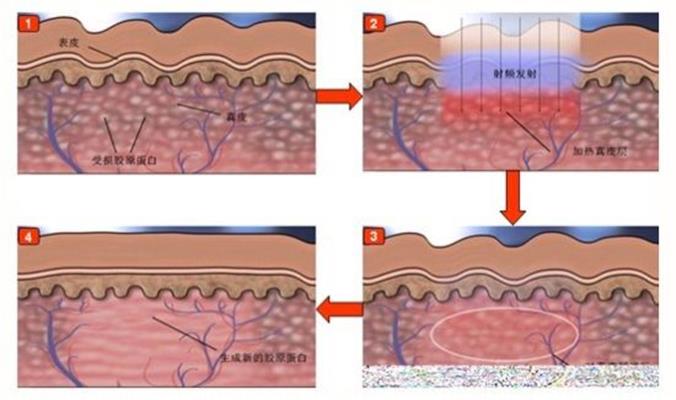 呼和浩特哪家醫(yī)院祛胎記效果好