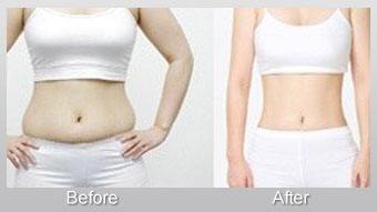 呼和浩特吸脂瘦身多少錢