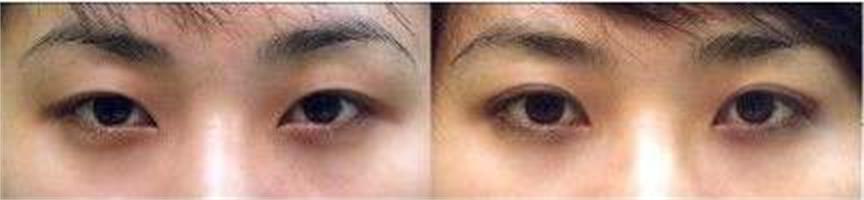 呼和浩特做埋線雙眼皮多少錢