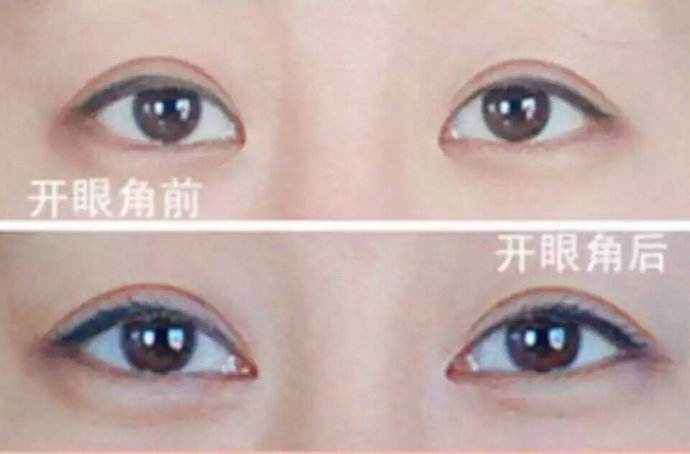 呼和浩特做開(kāi)眼角手術(shù)多少錢(qián)?