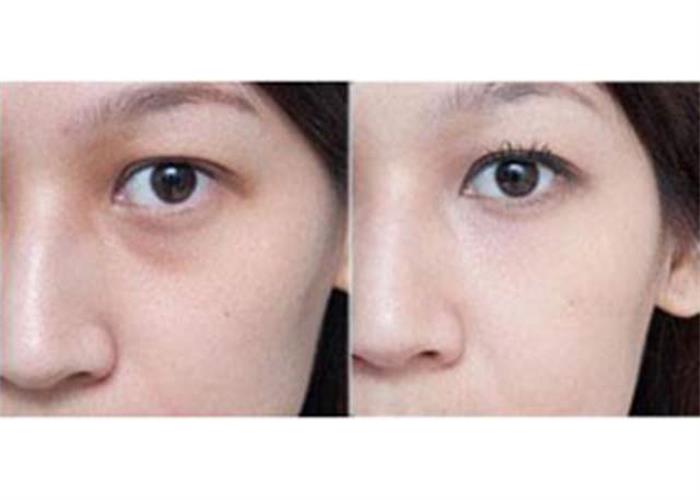 呼和浩特做激光祛眼袋手術(shù)多少錢