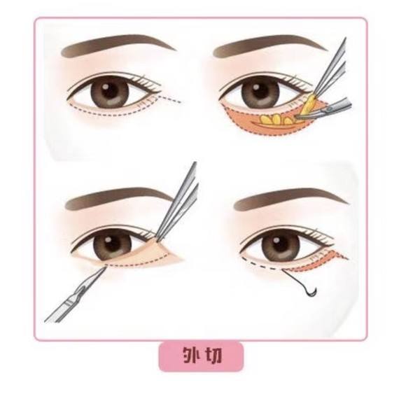 呼和浩特哪家做祛眼袋效果好