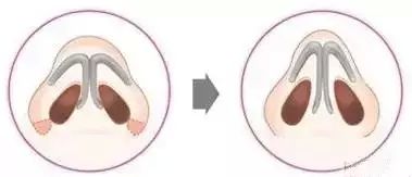 鼻翼縮小手術(shù)的價格多少