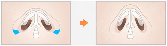 呼和浩特做鼻翼縮小效果怎么樣