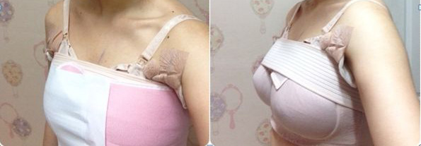 呼和浩特自體脂肪豐胸手術(shù)效果好不好