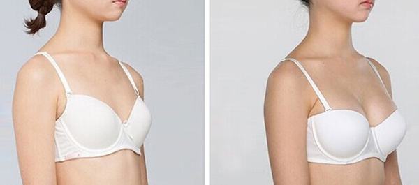 呼和浩特自體脂肪豐胸多少錢