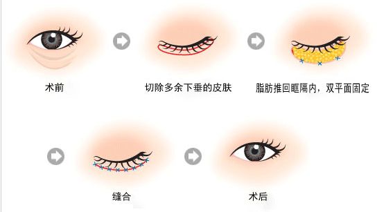 呼和浩特祛眼袋手術(shù)多少錢(qián)