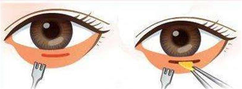 呼和浩特整形醫(yī)院做祛眼袋手術(shù)多少錢