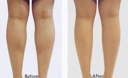 呼和浩特哪家醫(yī)院注射瘦腿效果好