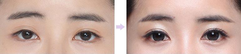 呼和浩特雙眼皮修復(fù)哪家好