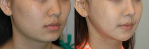 呼市面頰術(shù)前術(shù)后要注意哪些