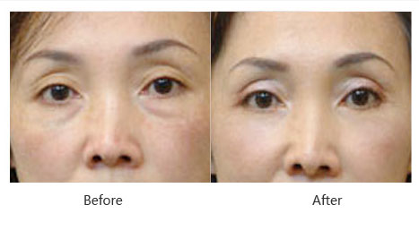 呼和浩特祛眼袋多少錢