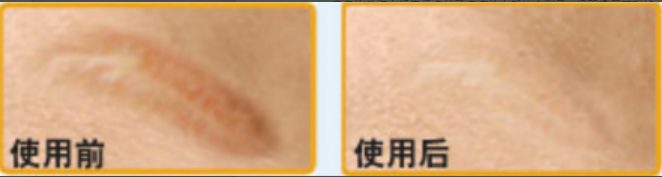 激光去疤痕多少錢呢