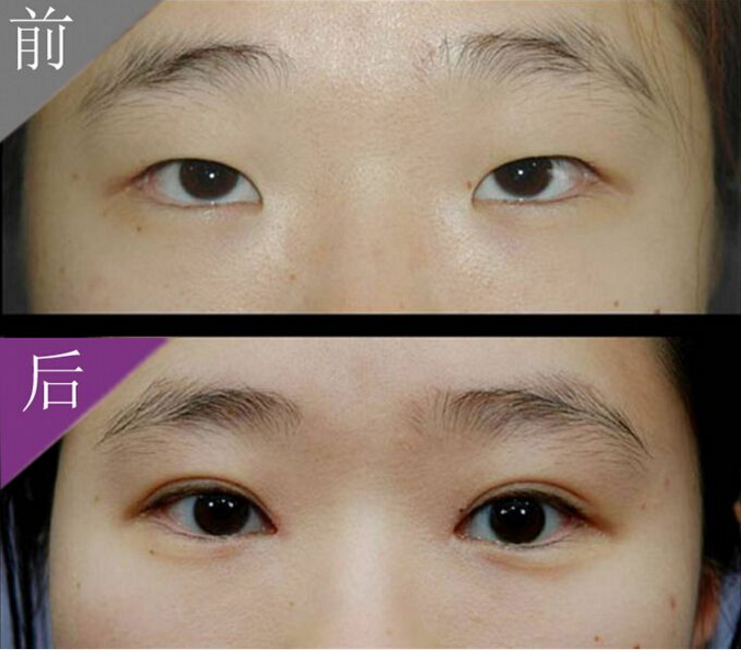 雙眼皮修復(fù)怎么樣