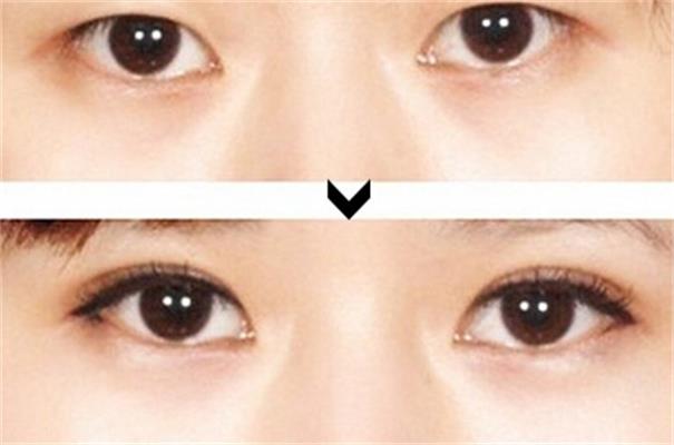 呼和浩特張高貴整形做雙眼皮有哪些優(yōu)勢