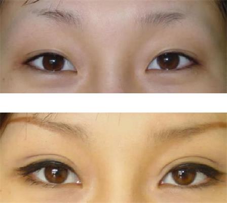 呼和浩特做雙眼皮大概多少錢