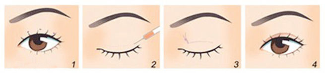 呼和浩特哪家做韓式雙眼皮效果好