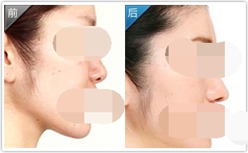 呼和浩特自體軟骨隆鼻多少錢