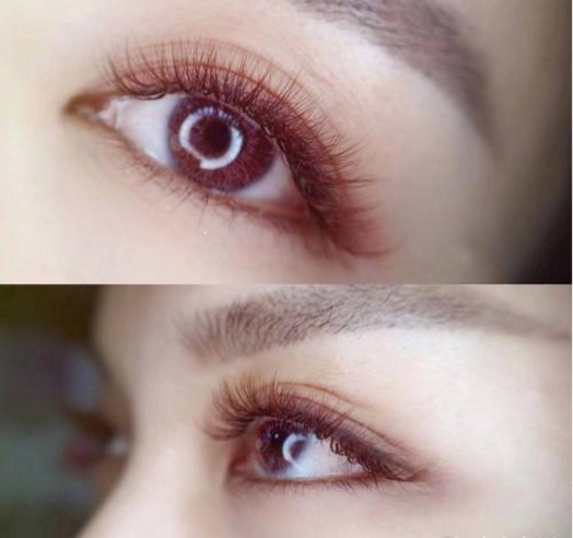 呼和浩特開眼角