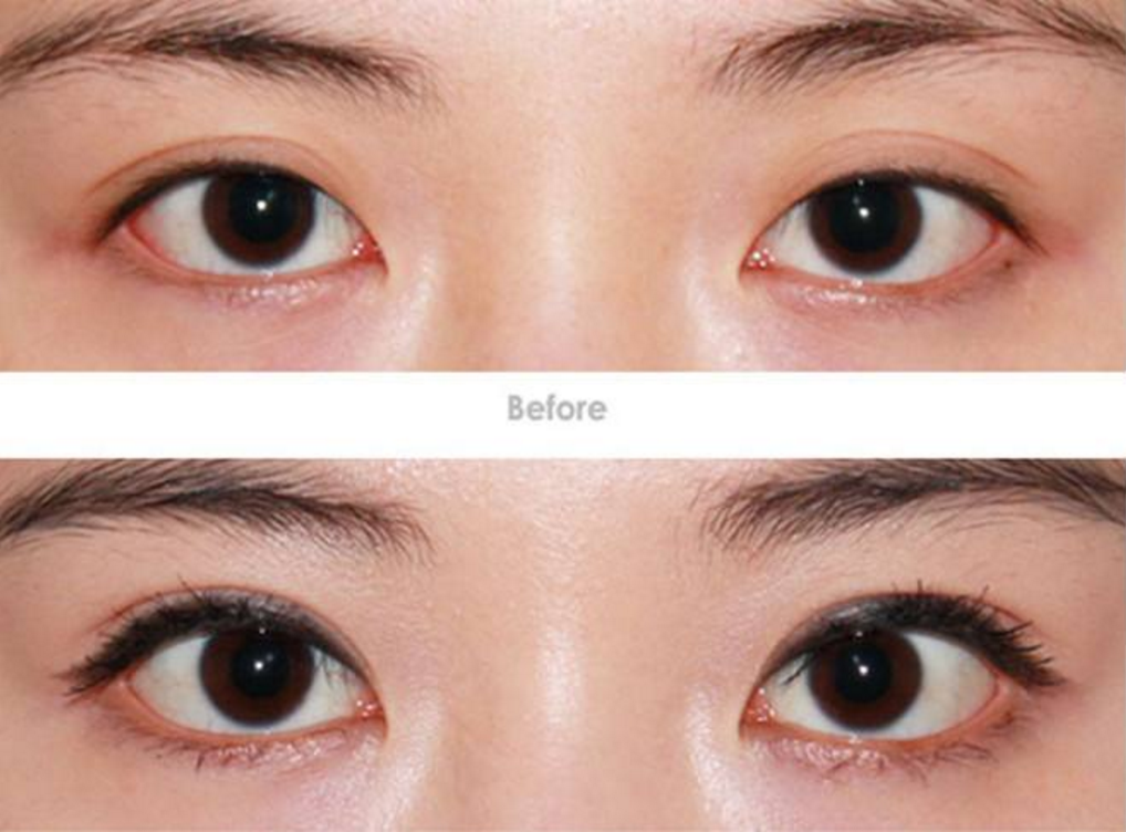 呼和浩特開眼角