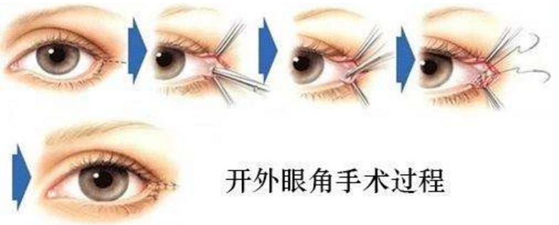 呼和浩特開(kāi)眼角